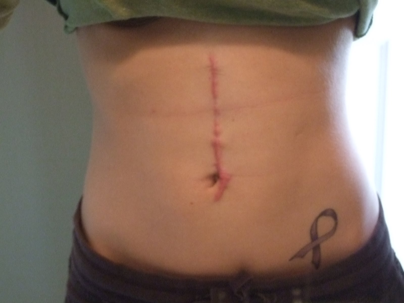 belly dialysis port