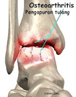 Pengapuran Sendi (Osteoarthritis)