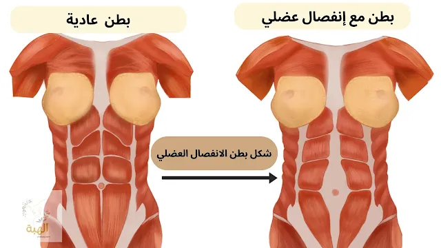 شكل بطن الانفصال العضلي