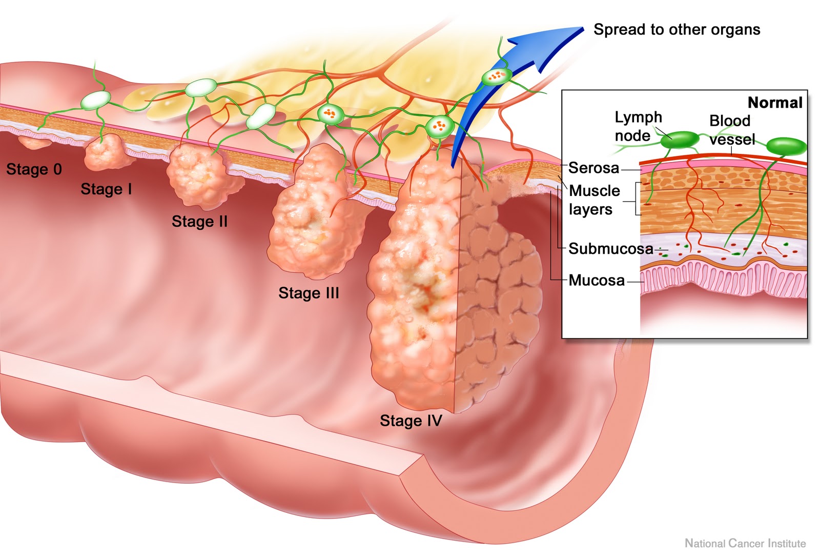 breast reconstruction flap vs implant