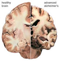 Obat Alzheimer Alami