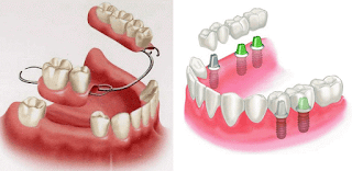 Nên chọn lựa loại răng sứ nào để phục hình cho răng cửa?