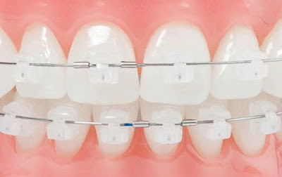 Nên niềng răng bằng mắc cài sứ hay invisalign?