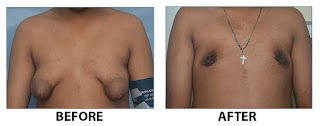 Male Breast Reduction Kerala India