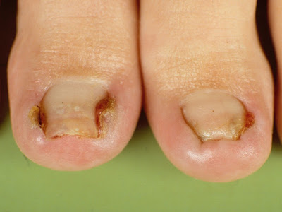 Ingrown Toenail Treatment: Surgery - What Is An Ingrown oenail?