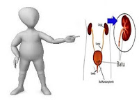 cara cepat menghancurkan batu ginjal tanpa operasi