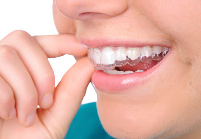 Phương pháp niềng răng không mắc cài  clear aligner 