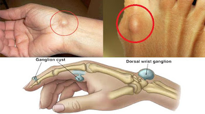 Cara Menghilangkan Benjolan Di Tangan