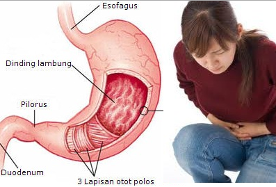 obat asam lambung