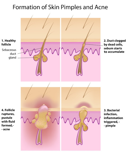 What causes Pimples