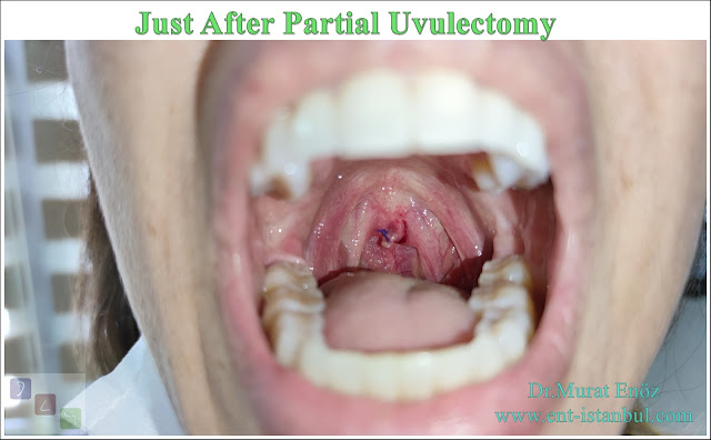 Oral Papillomas (Warts),uvulectomy,Papilloma of Uvula,oral HPV infection,Human Papillomavirus,Partial uvulectomy,