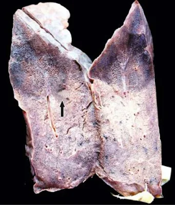 Infarct, haemorrhagic infarct, aasgaduli, pathology