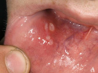 Bọng nước trong miệng cảnh báo bệnh nguy hiểm-1