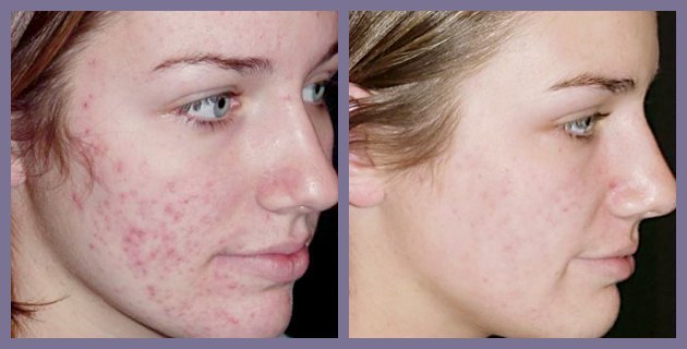 Solución de la cicatriz del acné