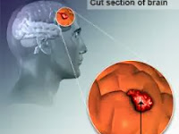 Obat Tumor Otak Alami