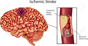 Cara Menyembuhkan Stroke Ringan, apa nama obat tradisional stroke hemoragik?, Bagaimana Cara Untuk Mengobati Stroke Ringan Dengan Cepat?