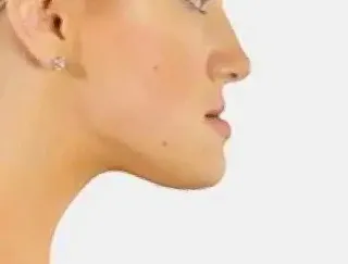 주걱턱-형태와-운세