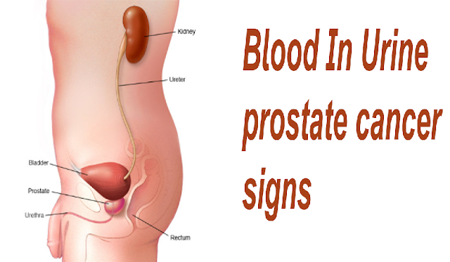 Early Warning Signs of Prostate Cancer