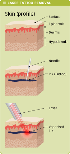 Tattoo Removal Before And After