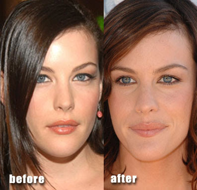  lip injections. Checkout this before and after picture of 