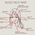 This Is What Your Acne Reveals About Your Health..