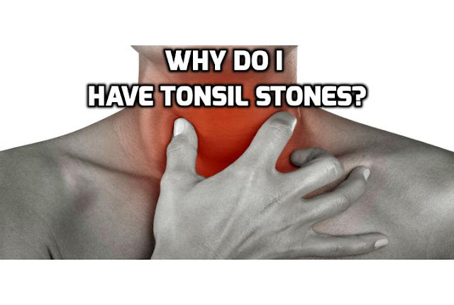 If you observe small, white masses on the back of your throat or have swollen tonsils, or suspect you may develop tonsil stones, see your doctor for a physical examination. Based on the results of this examination, he or she may recommend that you visit an ear, nose, and throat specialist for further treatment. 