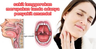 Obat Penyakit Amandel Alami