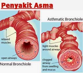 Obat Herbal Asma