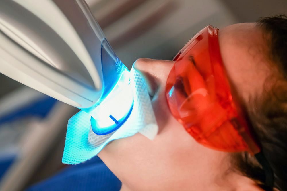 Teeth Whitening