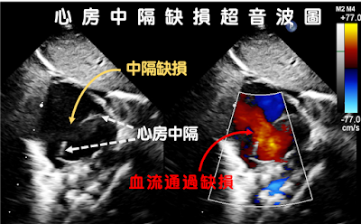 心房中隔缺損，超音波