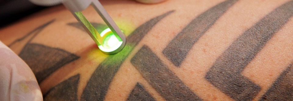 Erase Tattoo Removal: Popularity of Tattoos