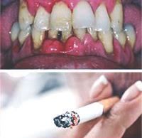 <Img src ="periodontitis_tabaquismo.jpg" width = "200" height "194" border = "0" alt = "Periodontitis crónica grave y tabaquismo.">