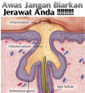 Tips Mengatasi Noda Jerawat