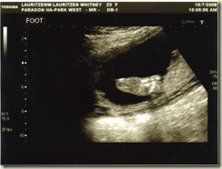 2nd Ultrasound 03 Foot