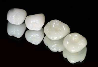 Truy lùng giá răng sứ cercon zirconia tại nha khoa rẻ nhất-1
