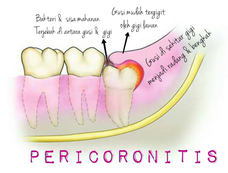 Radang Gusi Gigi Geraham Bengkak  Blog Sihatimerahjambu
