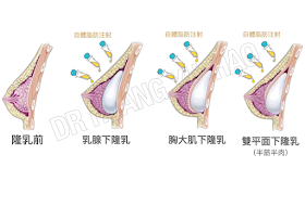 隆乳假體放置位置選擇