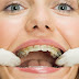 Quy trình niềng răng người lớn tại nha khoa