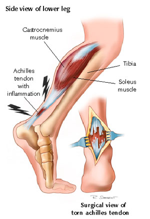 Achilles Tendinitis : Causes, Symptoms, Diagnosis, Treatment, Prevention