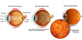 Differenc between the normal eye and Retinitis pigmentosaaffected eye.