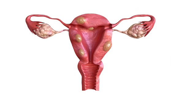 fibroid surgery in infertility patient in India