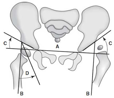 developmental dysplasia of the hip