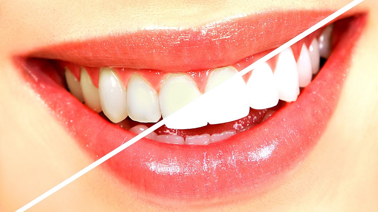 Most Effective Teeth Whitening Method