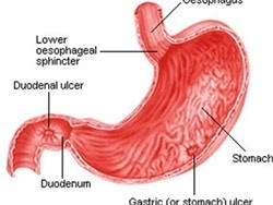 9 câu hỏi thường gặp về bệnh loét dạ dày