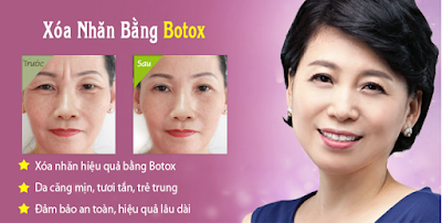 Xóa nếp nhăn bằng Botox