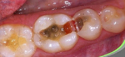 Trả lời nhổ răng cấm hàm dưới có nguy hiểm không 1
