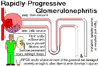 progressive Glomerulonephritis