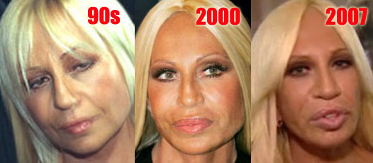Donatella Versace before and after plastic surgery over the years (image hosted by http://www.plasticcelebritysurgery.com)