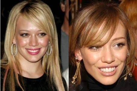 celebrity before and after veneers