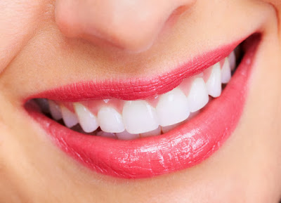 Tẩy trắng răng laser whitening